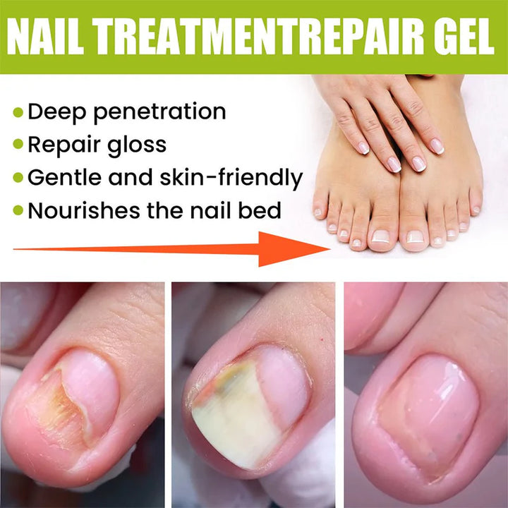 EELHOE Nail Repair Treatment Gel – Strengthening & Moisturizing Nail Care (20g)