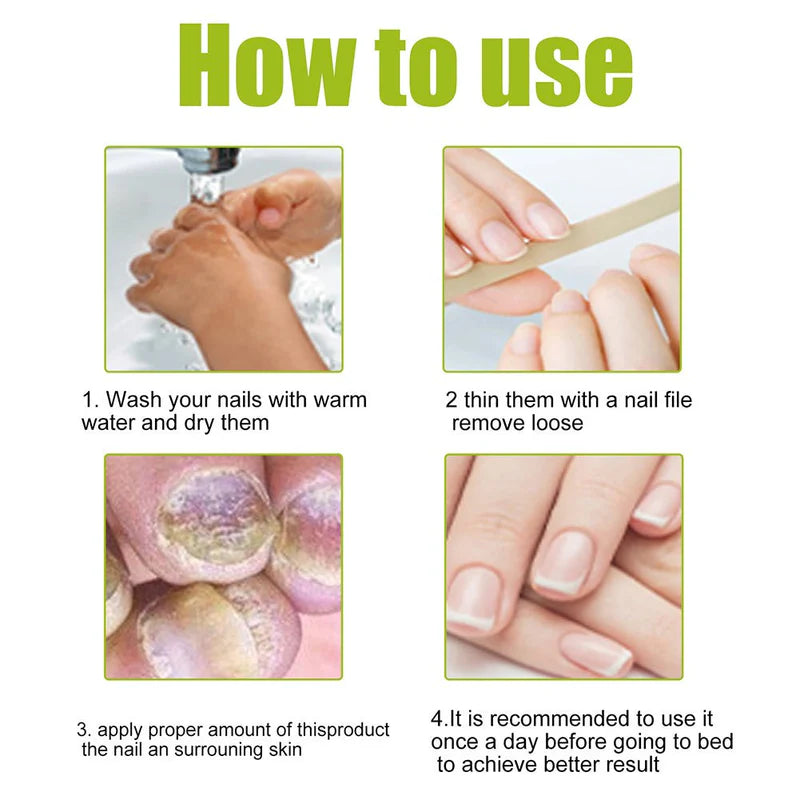 EELHOE Nail Repair Treatment Gel – Strengthening & Moisturizing Nail Care (20g)