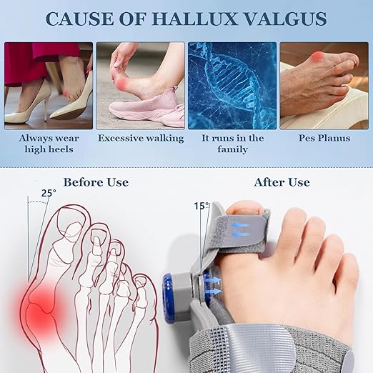FeetifFix Bunion Corrector – Adjustable Toe Alignment Support Brace (1 PCS)